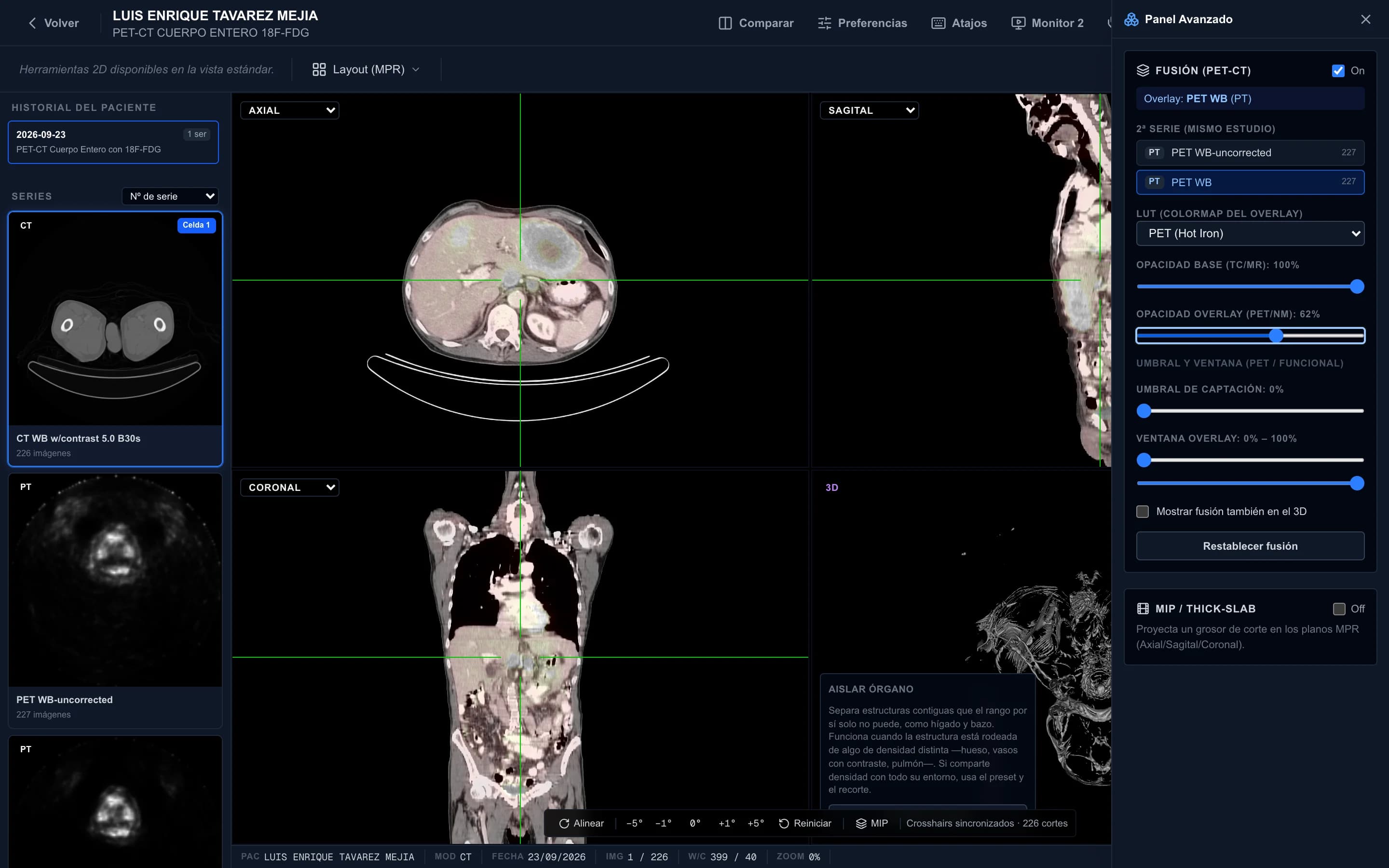 Fusión PET-CT